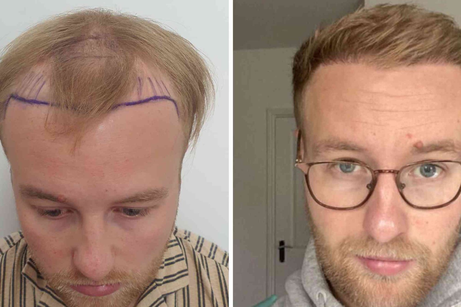Hair Transplant Turkey